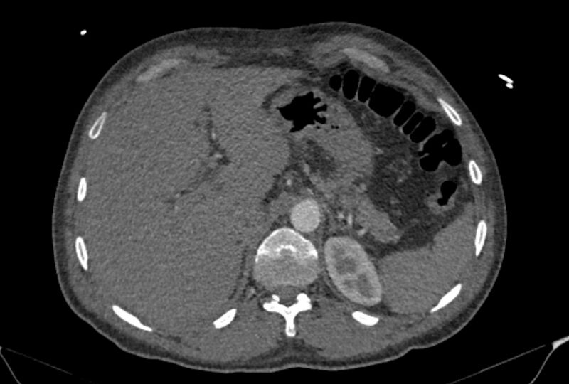 File:Ascending aortic aneurysm (Radiopaedia 86279-102297 C 67).jpg
