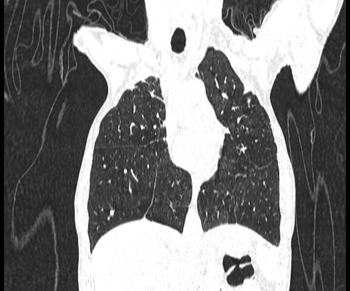 File:Aspergillomas (Radiopaedia 66779-76110 Coronal lung window 9).jpg