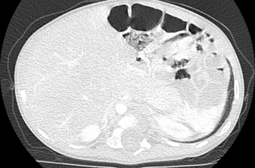 Asplenia syndrome (Radiopaedia 73083-83792 Axial lung window 76).jpg