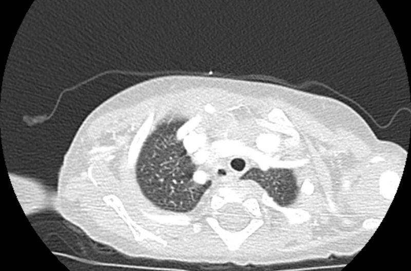 File:Asplenia syndrome (Radiopaedia 73083-83792 Axial lung window 8).jpg