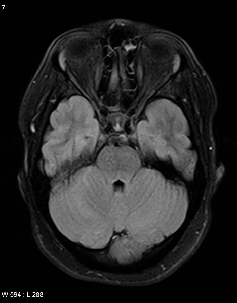 File:Astroblastoma (Radiopaedia 39792-42217 Axial FLAIR 6).jpg