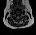 Astrocytoma - spinal cord (Radiopaedia 69769-79758 Axial T2 10).jpg