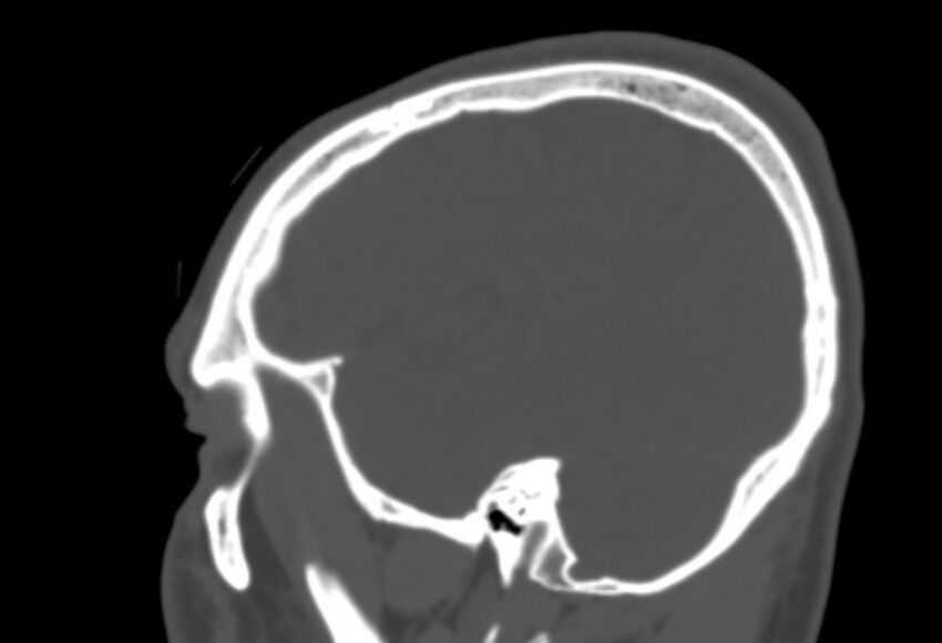 Asymptomatic occipital spur (Radiopaedia 87753-104201 Sagittal bone window 245).jpg