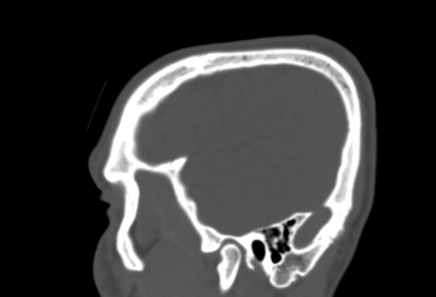 Asymptomatic occipital spur (Radiopaedia 87753-104201 Sagittal bone window 38).jpg