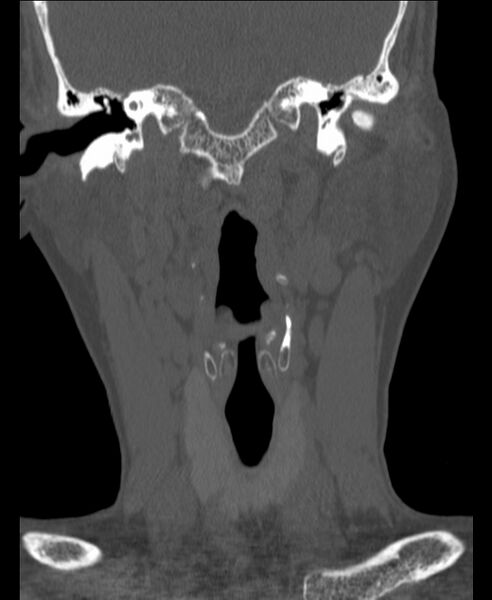 File:Atlanto-occipital assimilation with basilar invagination (Radiopaedia 70122-80188 Coronal bone window 33).jpg