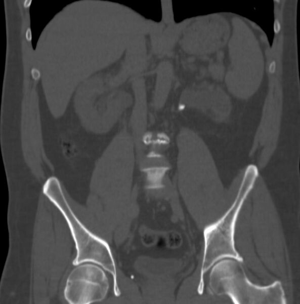 File:Atrophic kidney due to severe chronic obstructive hydronephrosis (Radiopaedia 40828-43474 Coronal bone window 4).jpg