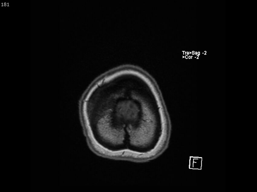 Atypical meningioma - intraosseous (Radiopaedia 64915-74572 Axial T1 181).jpg
