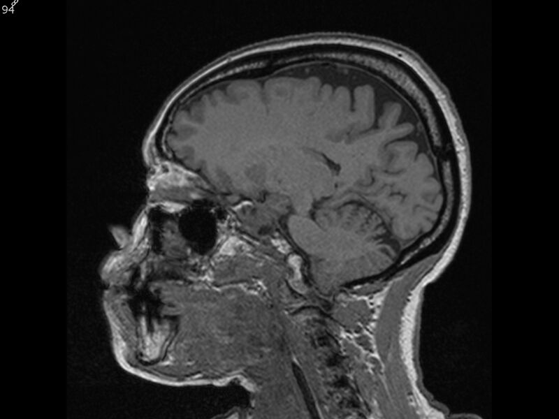 File:Atypical meningioma - intraosseous (Radiopaedia 64915-74572 Sagittal T1 94).jpg