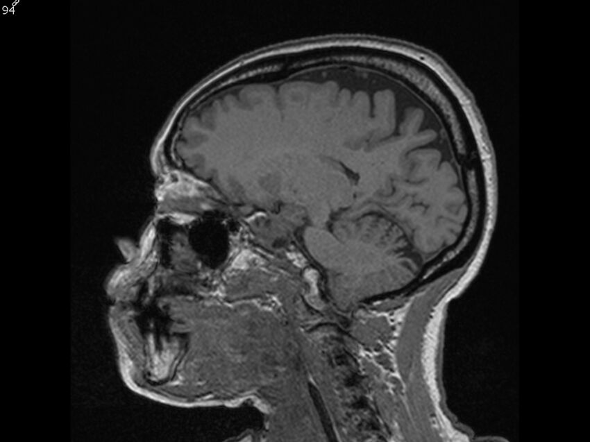Atypical meningioma - intraosseous (Radiopaedia 64915-74572 Sagittal T1 94).jpg