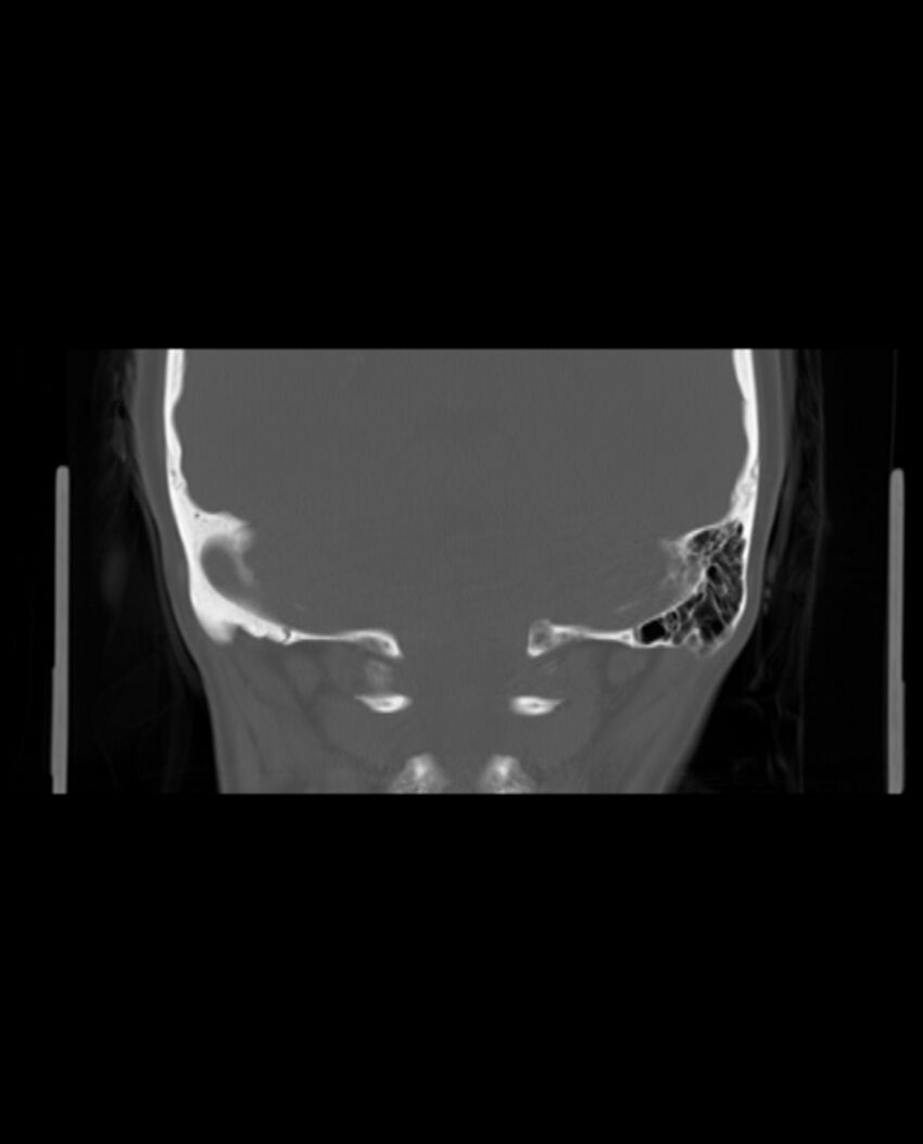 Automastoidectomy with labyrinthine fistula (Radiopaedia 84143-99411 Coronal non-contrast 115).jpg
