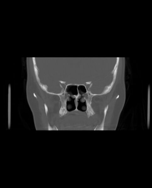 File:Automastoidectomy with labyrinthine fistula (Radiopaedia 84143-99411 Coronal non-contrast 54).jpg