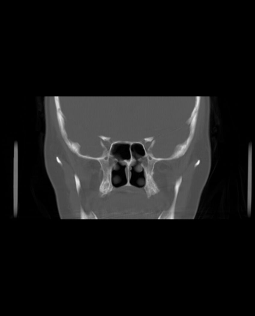 Automastoidectomy with labyrinthine fistula (Radiopaedia 84143-99411 Coronal non-contrast 54).jpg