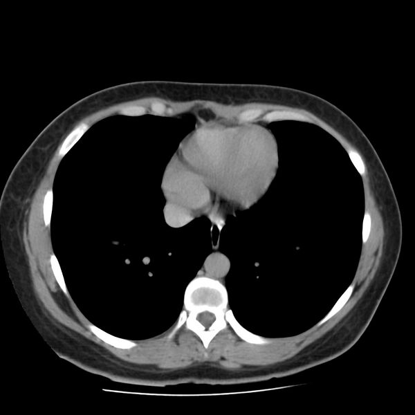 File:Autosomal dominant polycystic kidney disease (Radiopaedia 23061-23093 C+ delayed 1).jpg