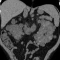 Autosomal dominant polycystic kidney disease (Radiopaedia 36539-38101 Coronal non-contrast 19).jpg