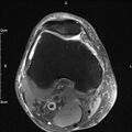 Avulsion fracture of the fibular head (Radiopaedia 74804-85808 Axial PD fat sat 11).jpg