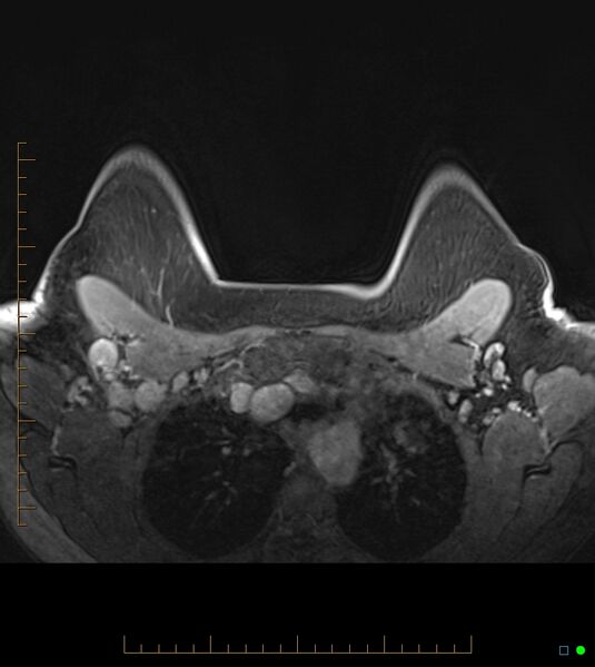 File:Axillary lymphadenopathy on breast MRI- yellow fever vaccination induced (Radiopaedia 19454-19483 Axial T1 C+ fat sat 16).jpg