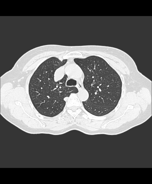 File:Azygos fissure and azygos lobe (Radiopaedia 41841-44832 Axial lung window 23).jpg