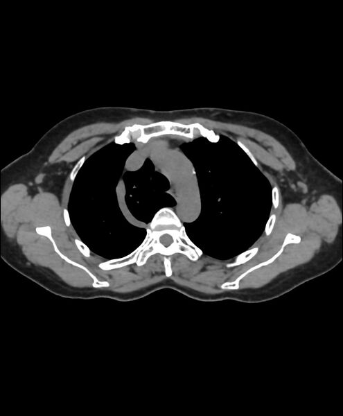 File:Azygos fissure and azygos lobe (Radiopaedia 41841-44832 Axial non-contrast 4).jpg