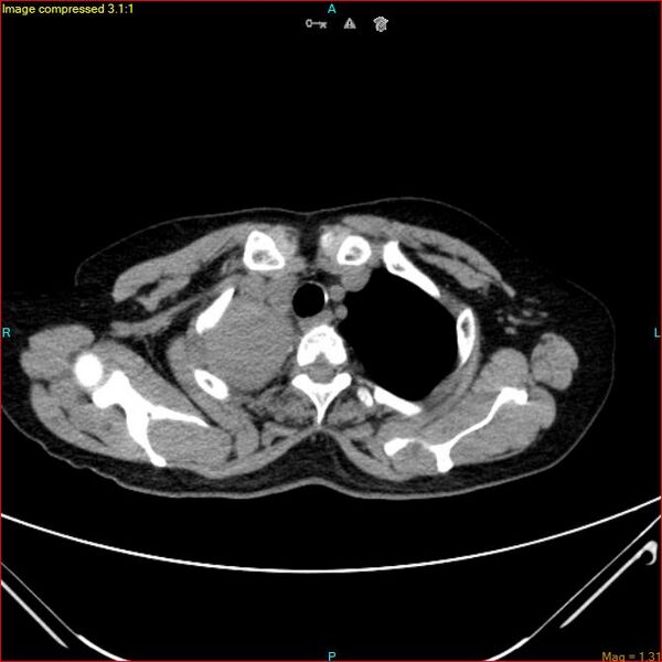 File:Azygos vein aneurysm (Radiopaedia 77824-90130 A 10).jpg