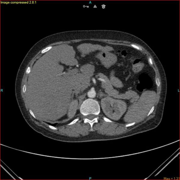 File:Azygos vein aneurysm (Radiopaedia 77824-90130 B 54).jpg
