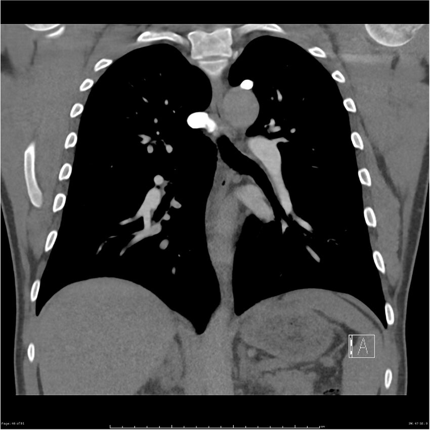 Azygos venous system anatomy (CT pulmonary angiography) (Radiopaedia 25928-26077 Coronal C+ CTPA 46).jpg