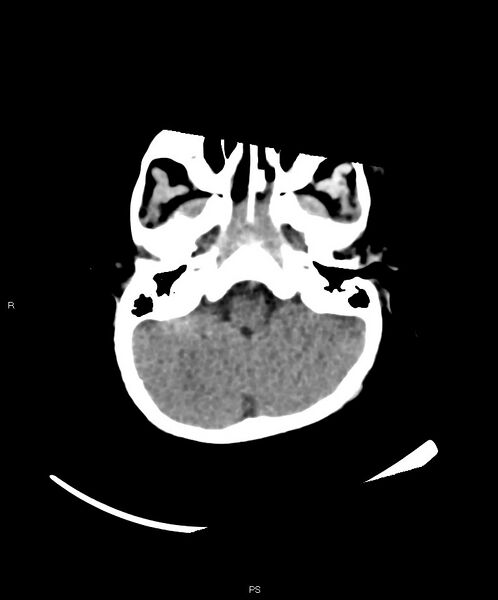 File:Basal ganglia and parenchymal ischemia (Radiopaedia 45818-50083 Axial non-contrast 37).jpg