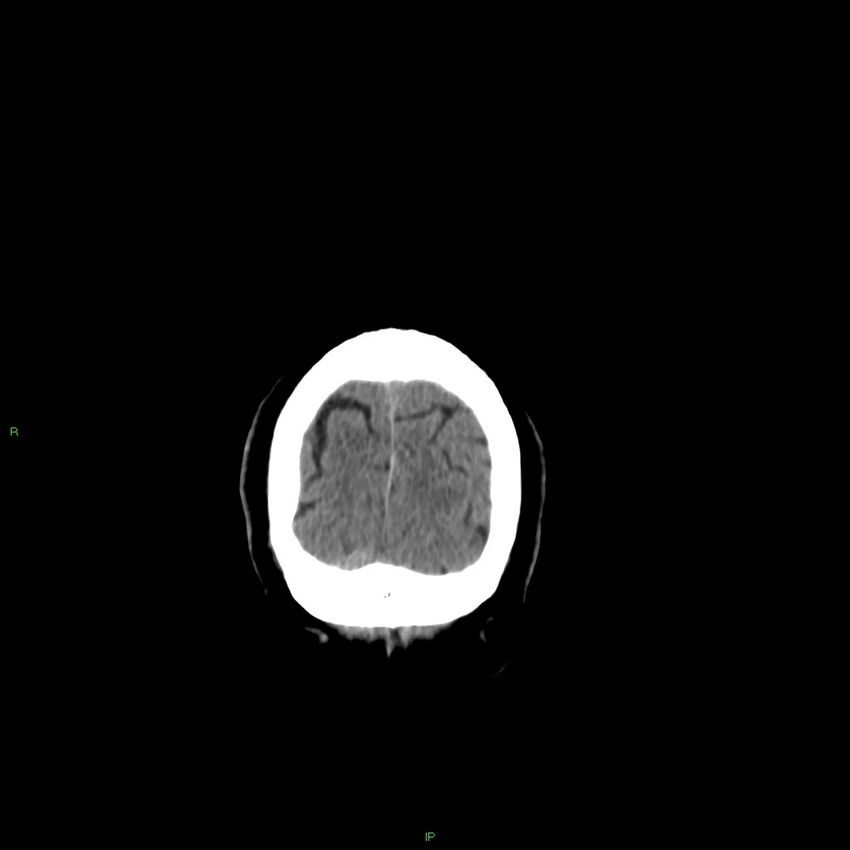 Basal ganglia hemorrhage (Radiopaedia 58346-65467 Coronal non-contrast 21).jpg