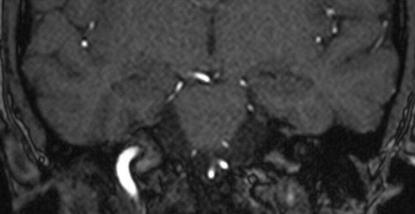 Basilar artery fenestration (Radiopaedia 74537-85455 Coronal MRA TOF 50).jpg