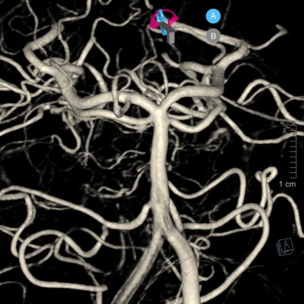 File:Basilar artery perforator aneurysm (Radiopaedia 82455-97734 3D view left VA 46).jpg