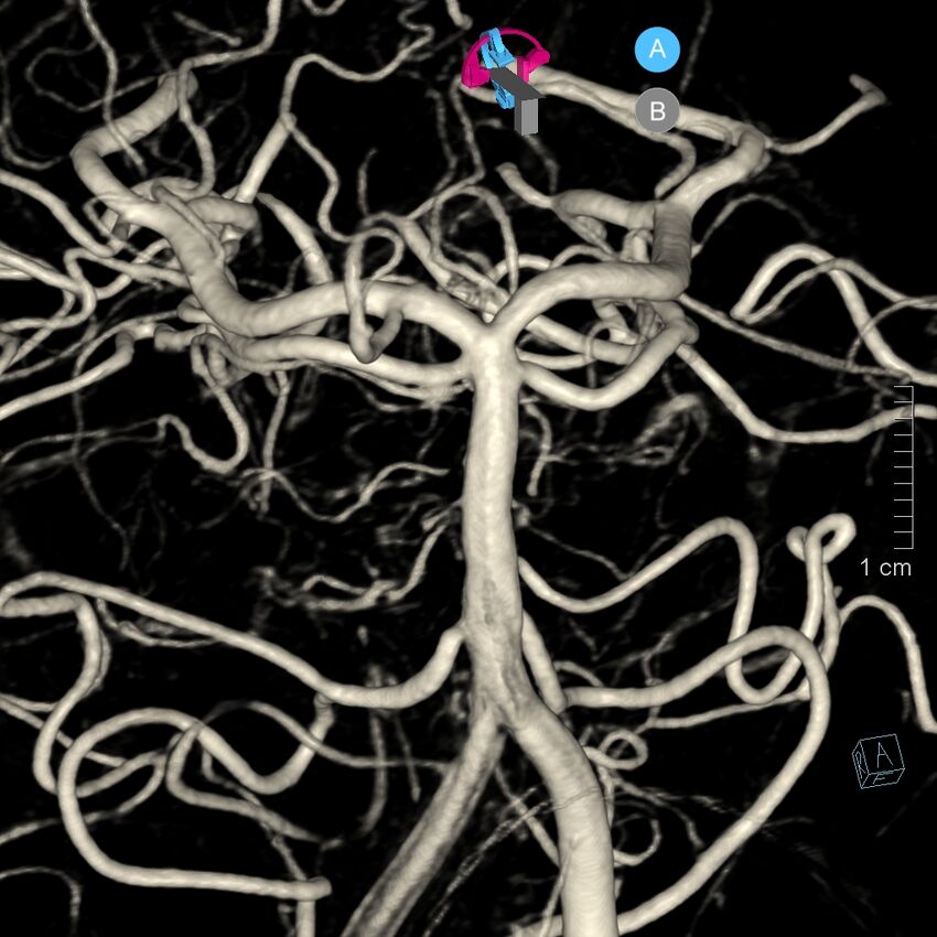 Basilar artery perforator aneurysm (Radiopaedia 82455-97734 3D view left VA 46).jpg