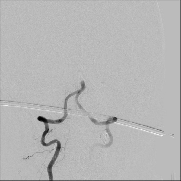 File:Basilar artery thrombosis treated with intra-arterial urokinase (Radiopaedia 34571-35949 A 15).png