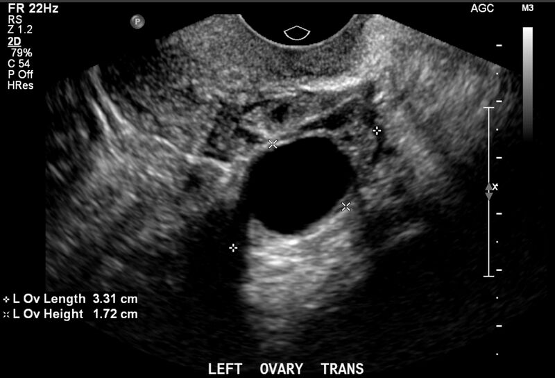 File:Benign non-simple ovarian cyst (Radiopaedia 78079).jpg