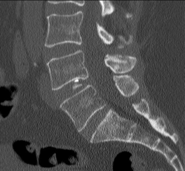 File:Bertolotti syndrome (Radiopaedia 24864-25128 Sagittal bone window 29).jpg