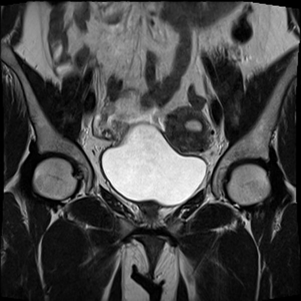 File:Bicornuate, unicollis uterus (Radiopaedia 79468-92593 Coronal T2 8).jpg