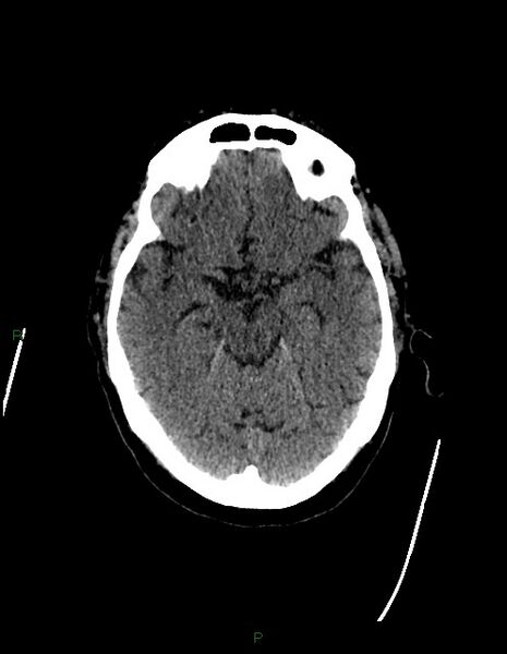 File:Bilateral acute middle cerebral artery territory infarcts (Radiopaedia 77319-89401 Axial non-contrast 33).jpg