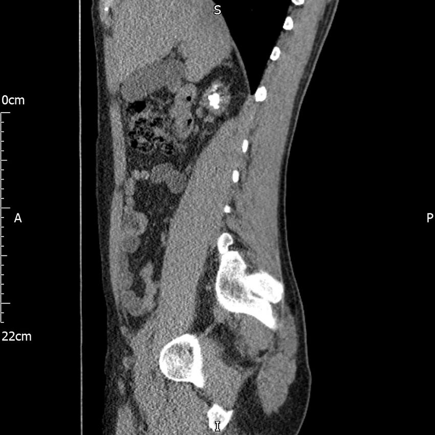 Bilateral medullary nephrocalcinosis with ureteric calculi (Radiopaedia 71269-81569 C 75).jpg