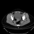 Bilateral ovarian mature cystic teratomas (Radiopaedia 79373-92457 Axial non-contrast 70).jpg