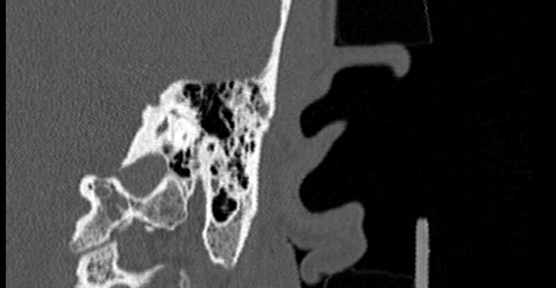 File:Bilateral temporal bone fractures (Radiopaedia 29482-29970 B 63).jpg