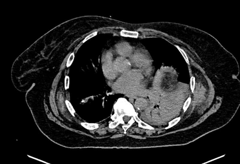 File:Biliary pancreatitis (Radiopaedia 72289-82823 Axial non-contrast 9).jpg
