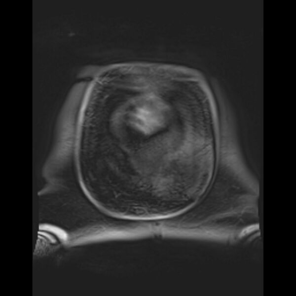 File:Bilobed placenta accreta (Radiopaedia 69648-79591 Coronal T1 vibe 7).jpg