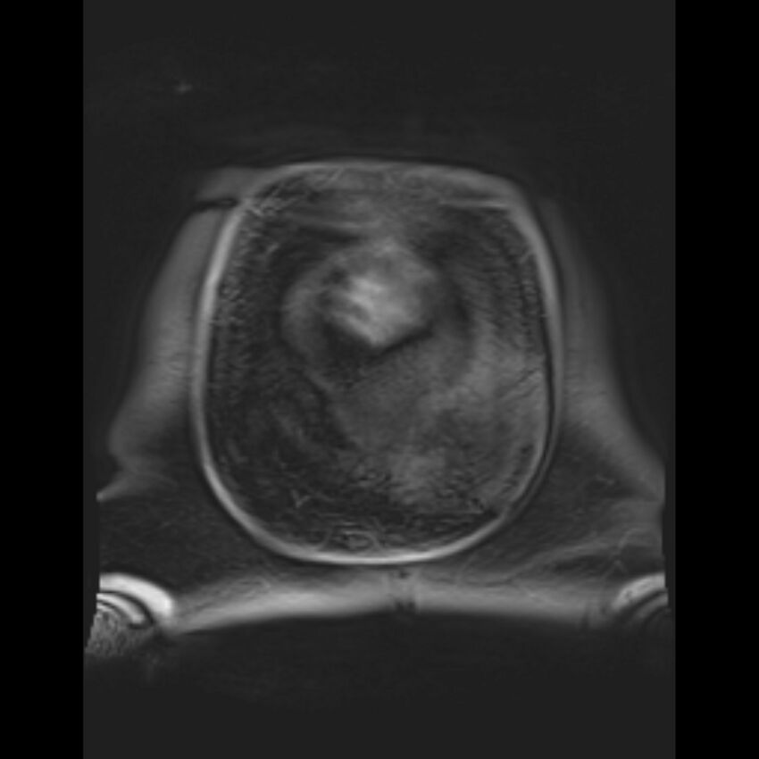 Bilobed placenta accreta (Radiopaedia 69648-79591 Coronal T1 vibe 7).jpg
