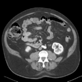 Bladder papillary urothelial carcinoma (Radiopaedia 48119-52951 A 28).png