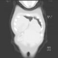 Bochdalek diaphragmatic hernia (Radiopaedia 38866-41059 Coronal lung window 3).jpg