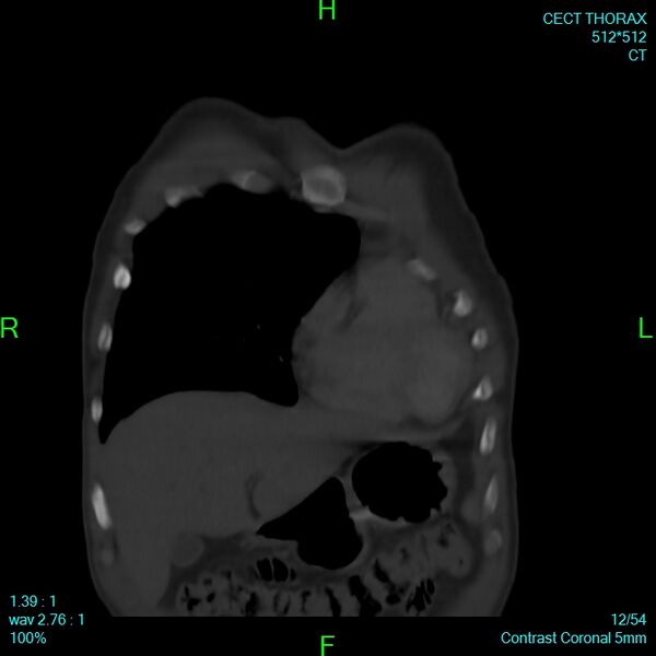 File:Bone metastases from lung carcinoma (Radiopaedia 54703-60937 Coronal bone window 12).jpg