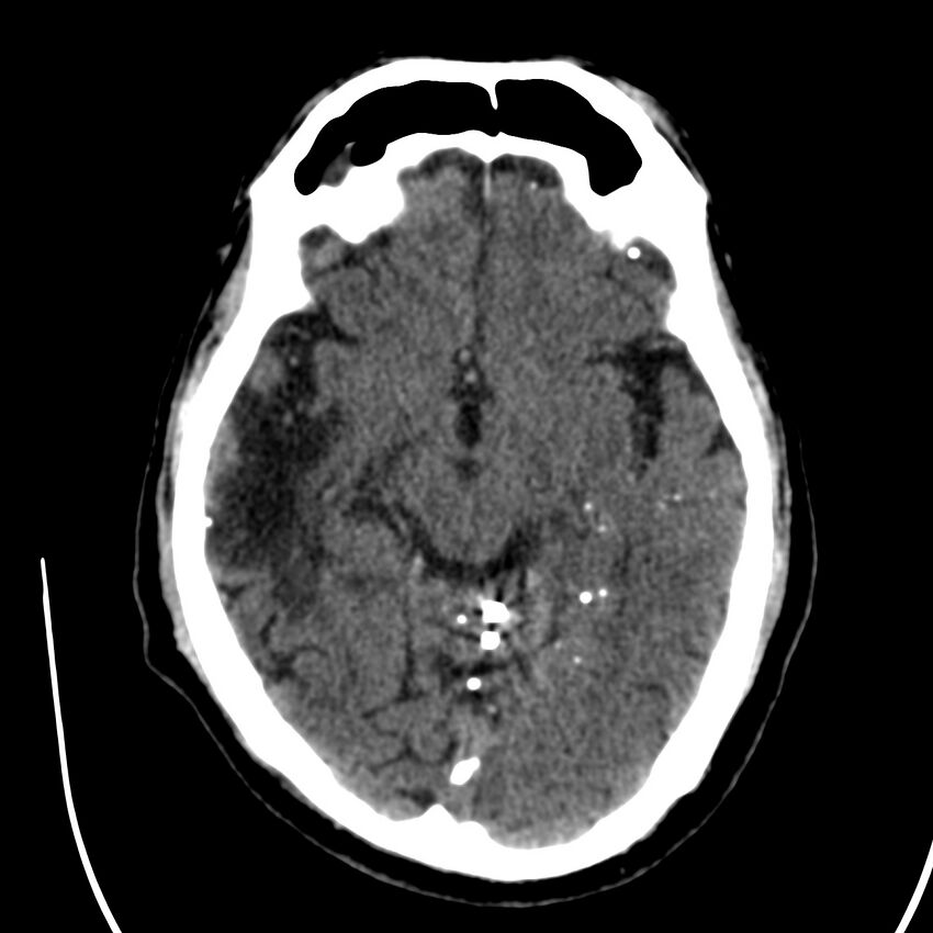 Brain Pantopaque remnants (Radiopaedia 78403-91048 Axial non-contrast 44).jpg