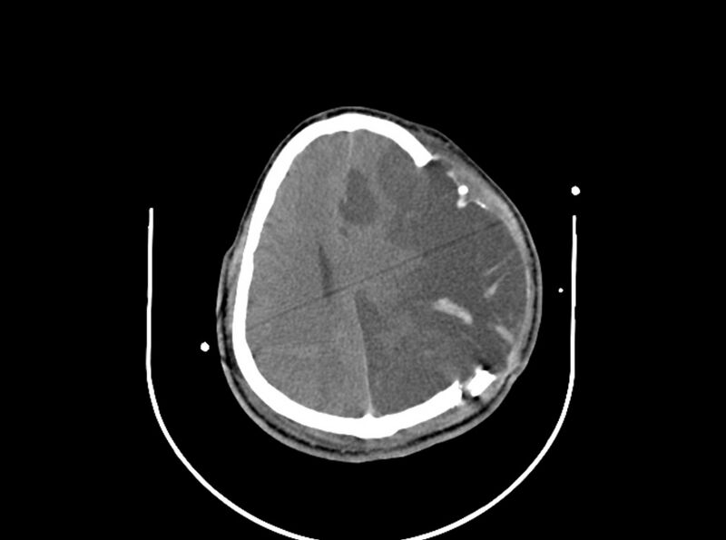 File:Brain injury by firearm projectile (Radiopaedia 82068-96087 B 131).jpg
