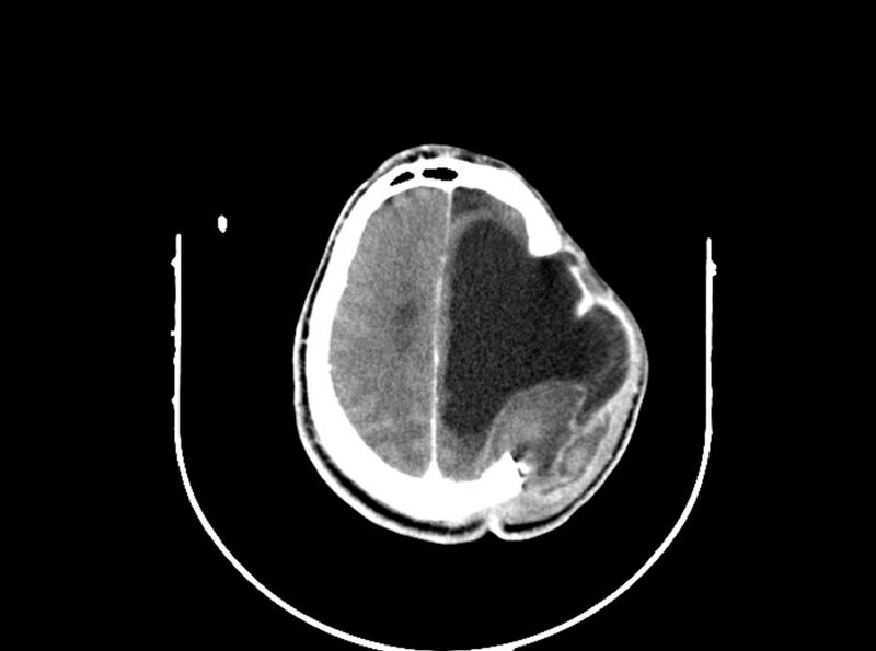 File:Brain injury by firearm projectile (Radiopaedia 82068-96088 B 169).jpg