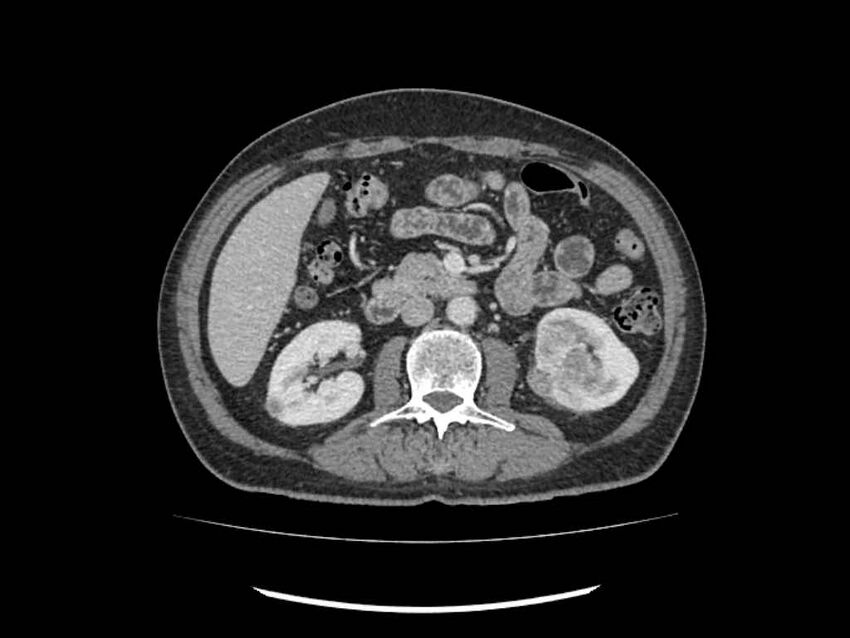 Brain metastases from renal cell carcinoma (Radiopaedia 42222-45328 B 110).jpg