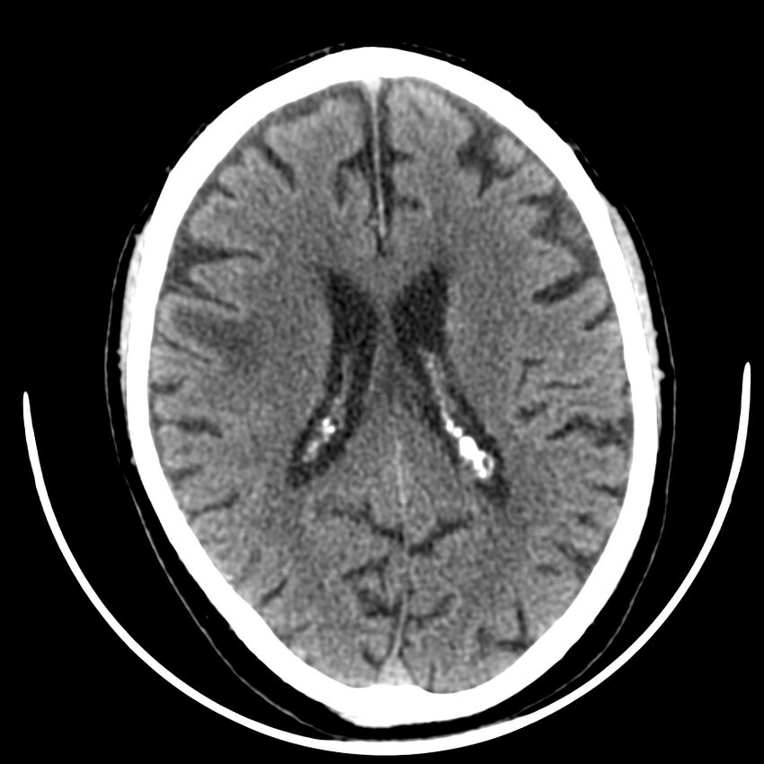 Brain metastasis (Radiopaedia 42617-45760 Axial non-contrast 28).jpg