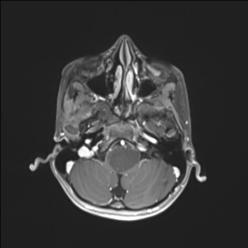 Brainstem glioma (Radiopaedia 70548-80674 Axial T1 C+ 35).jpg
